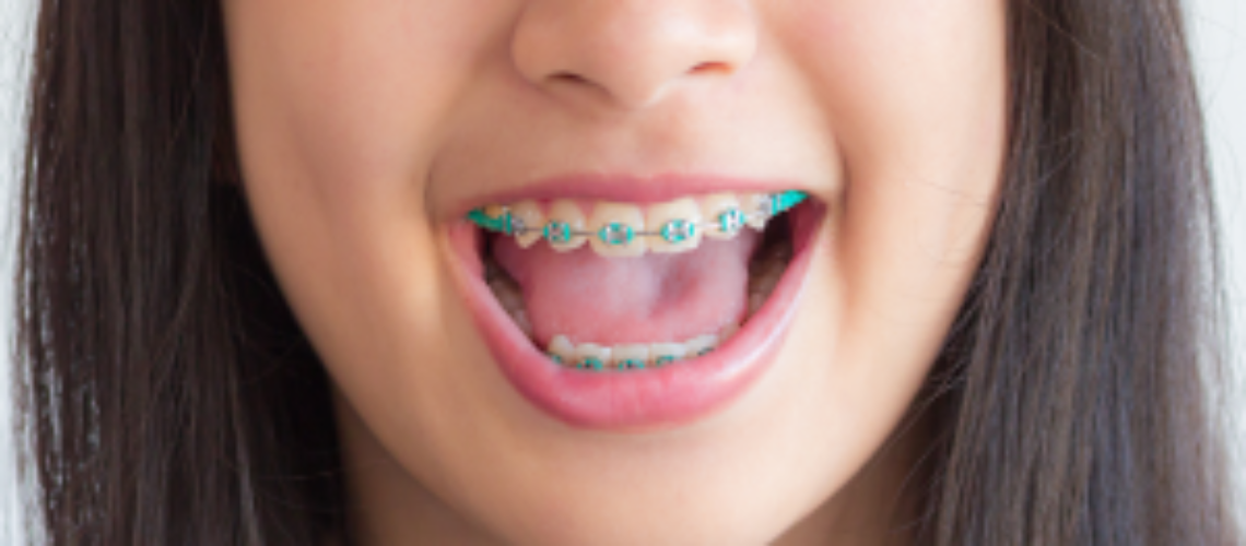 How-Do-I-Know-If-My-Child-Needs-Early-Phase-Braces-300x150